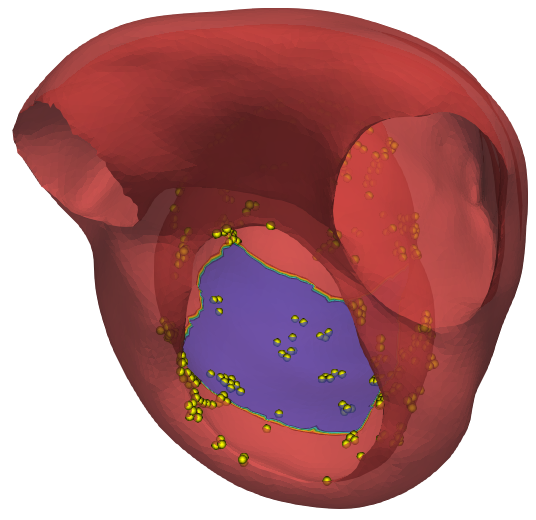 Target scar region from measured electrocardiography data